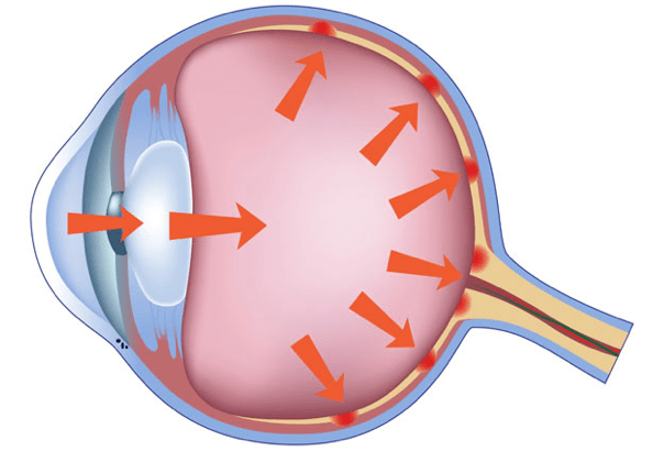 Tensión ocular